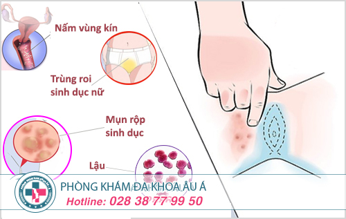 Những bệnh vùng kín ở nữ giới nên lưu ý