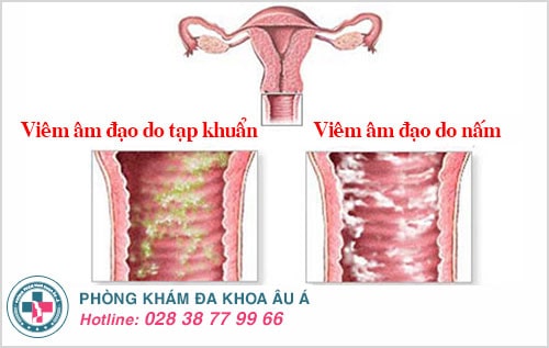 khí hư đặc