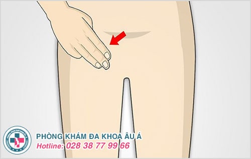 Nổi hạch vùng kín ở nam và nữ là bệnh gì?