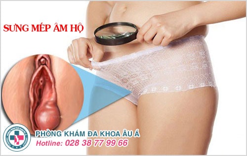 sưng mép âm hộ