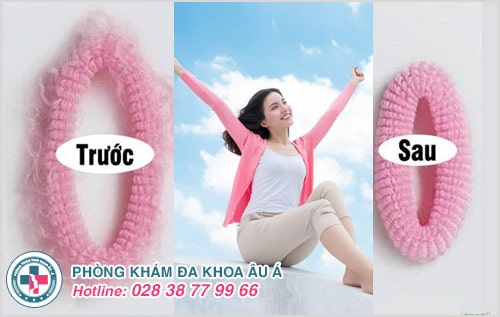 Chị Em Rủ Nhau Thu Hẹp Âm Đạo, Trẻ Hóa Vùng Kín Tại Âu Á