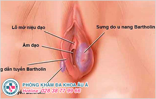 U cục sưng cứng gần âm đạo 