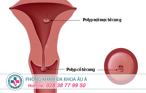 Hé lộ  cách điều trị polyp cổ tử cung nhanh