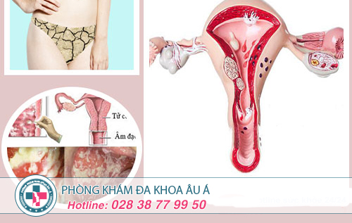 Lở loét vùng kín nữ là dấu hiệu của bệnh gì?