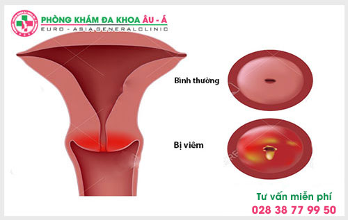 Nguyên nhân và cách phòng tránh bệnh viêm cổ tử cung