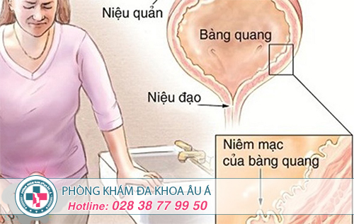 Nhiễm trùng đường tiểu nữ giới là gì