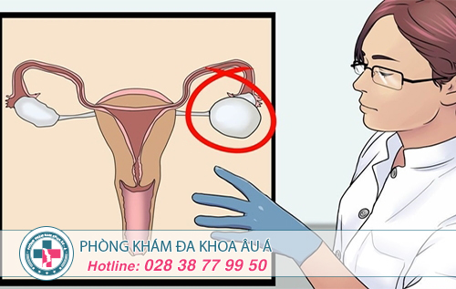 
																									Phương pháp điều trị u nang buồng trứng hiệu quả