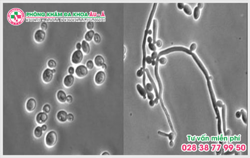 Viêm âm đạo do nấm - điều trị với phương pháp tiên tiến