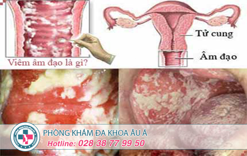Dấu Hiệu Viêm Âm Đạo Là Gì?