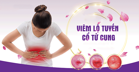 Thông tin cần biết về viêm lộ tuyến cổ tử cung
